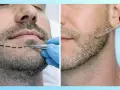 Doble imagen: un hombre con línea marcada en la barba y un aplicador, y otro hombre recibiendo gotas de minoxidil.