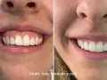 Uśmiech z widocznymi zębami i dziąsłami, porównanie przed i po zabiegu. Zniknął problem gummy smile.