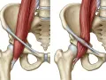 Anatomia biodra z widocznym mięśniem biodrowo-lędźwiowym, ilustrująca mechanizm zespołu trzaskającego biodra.