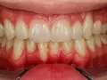 Ból dziąseł? Szybka ulga, domowe sposoby i kiedy do dentysty