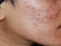Primo piano del viso di una persona con evidenti cicatrici da acne sul lato destro della guancia e sul mento.