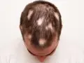 Calvizie a chiazze sulla testa di un uomo, sintomo di alopecia da stress.