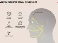 Ilustracja przedstawia przyczyny zapalenia nerwu twarzowego, w tym neuralgia nerwu trójdzielnego, choroby wirusowe, nowotwory, problemy stomatologiczne, zaburzenia naczyń mózgowych i zapalenie mięśni.