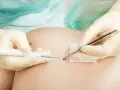 Arzt entfernt mit Pinzette und Laser ein Muttermal rot umrandet.