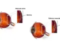 Confronto tra occhio sano e occhio con edema maculare. L'edema maculare si riassorbe, mostrando la retina gonfia e piena di liquido.