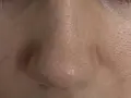 Primo piano del naso con evidenti punti neri, la pelle appare lucida e porosa.
