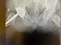 Endoproteza stawu biodrowego nfz gdzie najlepiej – wybierz mądrze