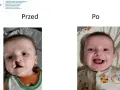 Uśmiechnięte dziecko po korekcie rozszczepu wargi. Wcześniej widoczna była zajęcza warga.