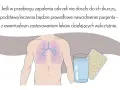 Kiedy hospitalizować dziecko z zapaleniem oskrzeli? Objawy i porady