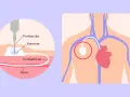 Illustration zeigt eine Portkanüle, die in eine Vene eingeführt wird, um Chemotherapie zu verabreichen.