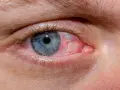 Occhio azzurro con congiuntiva arrossata e vasi sanguigni evidenti. Esistono gli occhi rossi, un segno di irritazione o infezione.