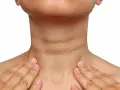 Cuello con piel oscura y arrugada, indicativo de acantosis nigricans. Se buscan opciones de tratamiento.