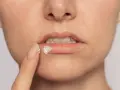 Palec nakłada krem na spierzchnięte, **suche usta**, przynosząc ulgę.