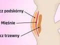 Ilustracja pokazuje przekrój brzucha, gdzie widać jak wygląda tłuszcz na brzuchu: podskórny i trzewny, oddzielone mięśniami.