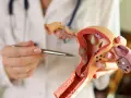 Lekarz pokazuje model narządów rodnych, wyjaśniając, czym jest endometrium.