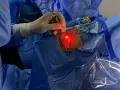 Un chirurgo esegue una vitrectomia, un intervento per rimuovere il corpo vitreo dall'occhio.