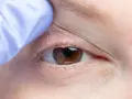 Occhio con palpebra sollevata da guanto blu, evidenziando arrossamento e possibili ghiandole di meibomio ostruite, cause di disagio.