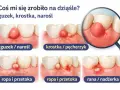 Ilustracja pokazuje różne zmiany na dziąśle: guzek, krostkę, ropień i ranę, które mogą powodować ból w jamie ustnej.