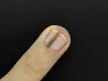 Un ongle de doigt présente une ligne verticale brune, un signe possible de carence en fer.