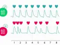 Dwa wykresy EKG pokazują rytm serca. Górny wykres z zielonym sercem i 60 BPM jest prawidłowy. Dolny z czerwonym sercem i 60 BPM ma nieregularny rytm.