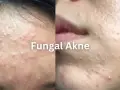 Hefepilz-Akne zeigt sich als kleine, rote Pickelchen auf Stirn und Wangen.