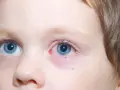 Occhio di bambino con congiuntivite, l'occhio rosso e irritato, con piccole vene visibili.