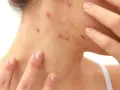 Haut mit Pickeln am Hals und Gesicht. Die Haut ist gerötet und entzündet.