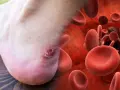 Blutblase am Zeh: Was tun? Nahaufnahme eines verletzten Zehs mit roten Blutkörperchen im Hintergrund.