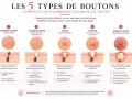 Les 5 types de boutons : comédon, papule, pustule, nodule/kyste. Apprenez à les reconnaître pour mieux les traiter et savoir comment enlever l'acné en une nuit.
