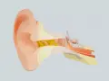 Sezione anatomica dell'orecchio con cerume giallo che blocca il condotto uditivo, impedendo all'acqua nelle orecchie di uscire.