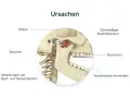 Kiefergelenk: Ursachen wie Stress, Rauchen, Bruxismus, Verletzungen, übermäßiger Alkoholkonsum und anatomische Anomalien. Physiotherapie Kiefergelenk was wird gemacht?