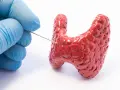 Ręka w niebieskiej rękawiczce wykonuje biopsję tarczycy, pobierając próbkę z czerwonego modelu gruczołu.
