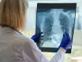 Lekarka w niebieskich rękawiczkach analizuje zdjęcie rentgenowskie płuc, szukając oznak rozstrzenie oskrzeli.