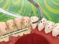 Piaskowanie zębów: Odzyskaj naturalny blask i gładkość. Poradnik
