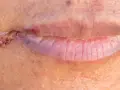 Czy z zajadami można iść do dentysty? Ważne informacje i porady