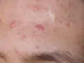 Haut mit Rötungen und kleinen Pickelchen, die auf eine mögliche Pilzakne hindeuten.
