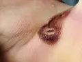 Nahaufnahme einer verbrannten Hautstelle, die wie eine Wasserblase aussieht. Die Behandlung dieser Verletzung ist wichtig.
