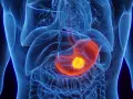 Anatomische Darstellung des menschlichen Oberkörpers mit hervorgehobenem Magen. Ein leuchtend gelber Tumor im Magen könnte ein Anzeichen für Magenkrebs sein.
