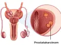 Was wird bei der Prostatakrebs Vorsorge gemacht? Wichtige Schritte erklärt
