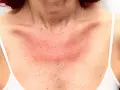 Här ser du hur soleksem kan se ut: röd, irriterad hud på bröstet och halsen, med små prickar.
