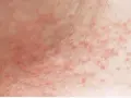 Piel con erupción de pequeños granos rojos, posiblemente por sudor.