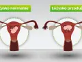 Porównanie: łożysko normalne vs łożysko przodujące. Na obrazku widać macicę z płodem. W przypadku łożyska przodującego, łożysko znajduje się na przedniej ścianie macicy.