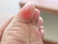 Gros plan sur un orteil rouge et enflammé, signe d'une ampoule au pied. La peau est irritée.