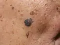Zbliżenie na skórę z licznymi przebarwieniami i ciemną, wypukłą zmianą. Widoczne suche plamy na twarzy.