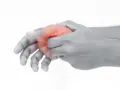 Hand mit roter Markierung am Daumenballen innen, die auf Schmerzen hindeutet.