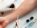 Ręce w rękawiczkach wykonują testy na alergie na przedramieniu, aplikując krople z fiolek.