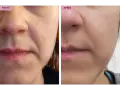 Comparaison avant/après : la peau semble plus lisse et les rides d'expression moins marquées grâce au bakuchiol.