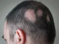 Haaransatz mit kahlen Stellen, die wie Pickel auf der Kopfhaut aussehen.