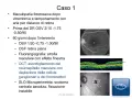 Caso 1: Maculopatia post-vitrectomia con bolla d'aria. Immagini OCT e SLO mostrano assottigliamento neuroepiteliale e scotoma.