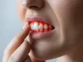 Widoczne spuchnięte dziąsło od wewnątrz, zaczerwienione i lekko krwawiące wokół zębów.